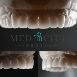 Full Mouth Restoration - Upper Teeth Design