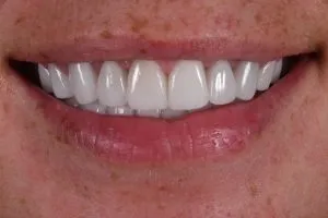 Final smile after Crowns have been placed Case 