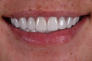 Final smile after Crowns have been placed Case 