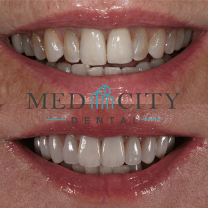 Before & After Case Smile Gallery #2