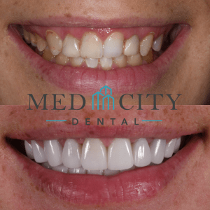 Before & After Case Smile Gallery #1