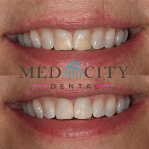 Before & After Smile Gallery Case