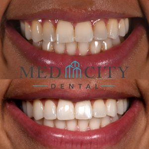 Before & After Teeth Whitening Case
