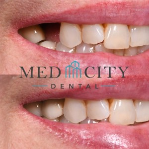 Before & After Fixed Prosthodontics - Smile Gallery