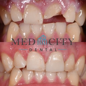 Before & After Case Smile Gallery #5