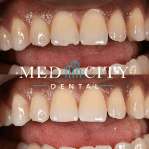 before and after Complex Restorative and Full Mouth Reconstruction