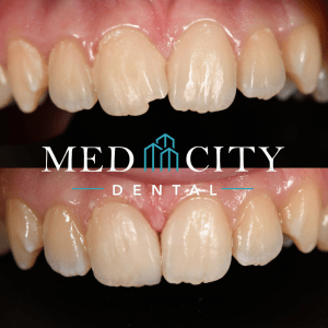 before and after Complex Restorative and Full Mouth Reconstruction