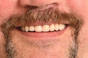 Close-up of a smiling man with a mustache, showing well-fitted dentures