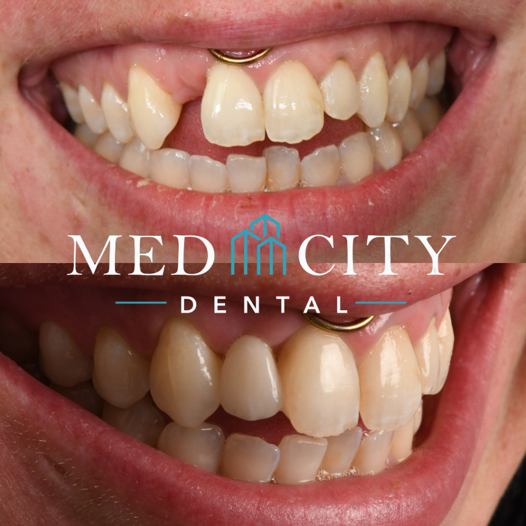 before and after tooth replacement Options