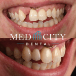 before and after tooth replacement Options