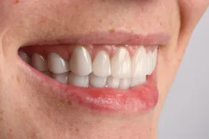 Complex Restorative and Rehabilitation (Full Mouth)