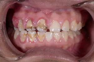 Periodontal Maintenance