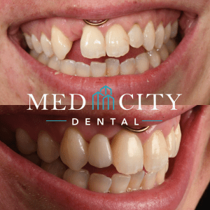 Dental Bridges - Before & After