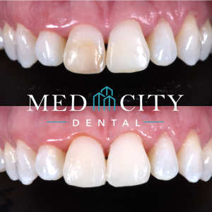 Complex Restorative and Rehabilitation (Full Mouth) - Before & After