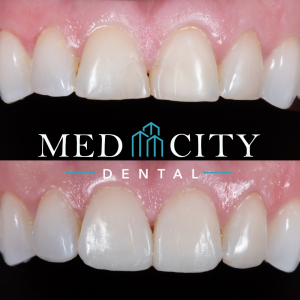 Smile design