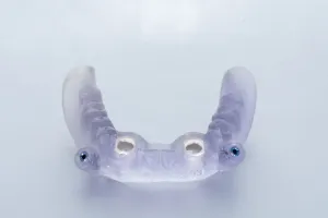 Tooth replacement options