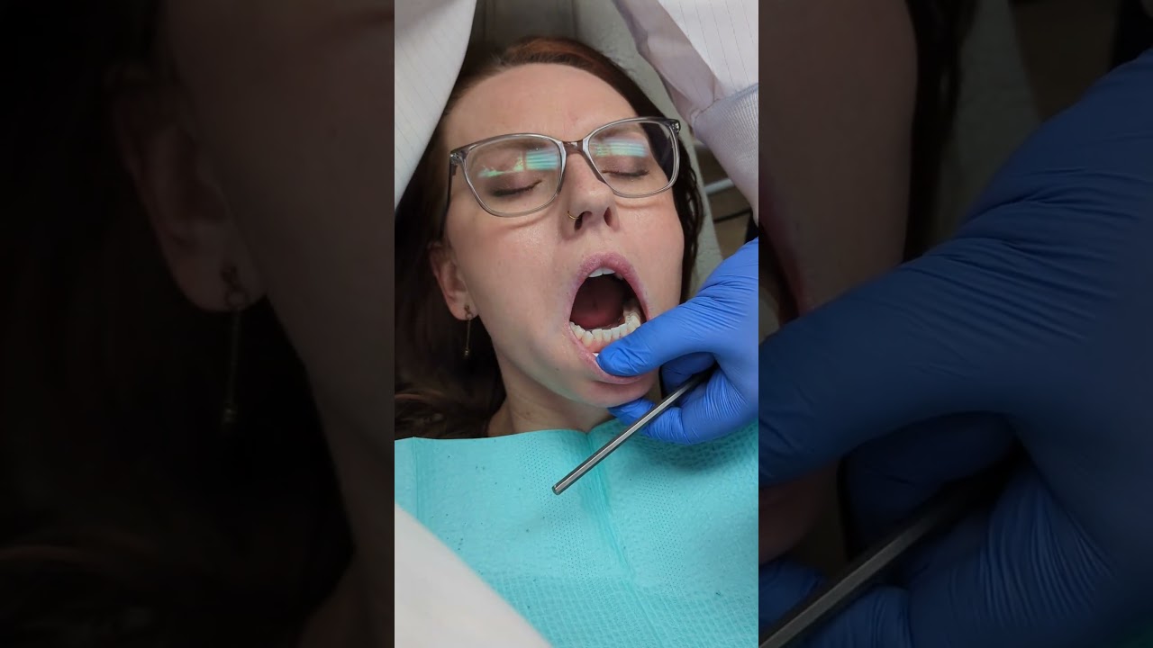 Clear Aligner Braces Video Thumbnail