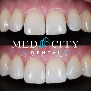 Diastema Closure