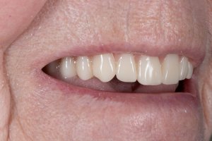 Dental implants 4