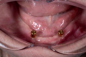 Dental implants