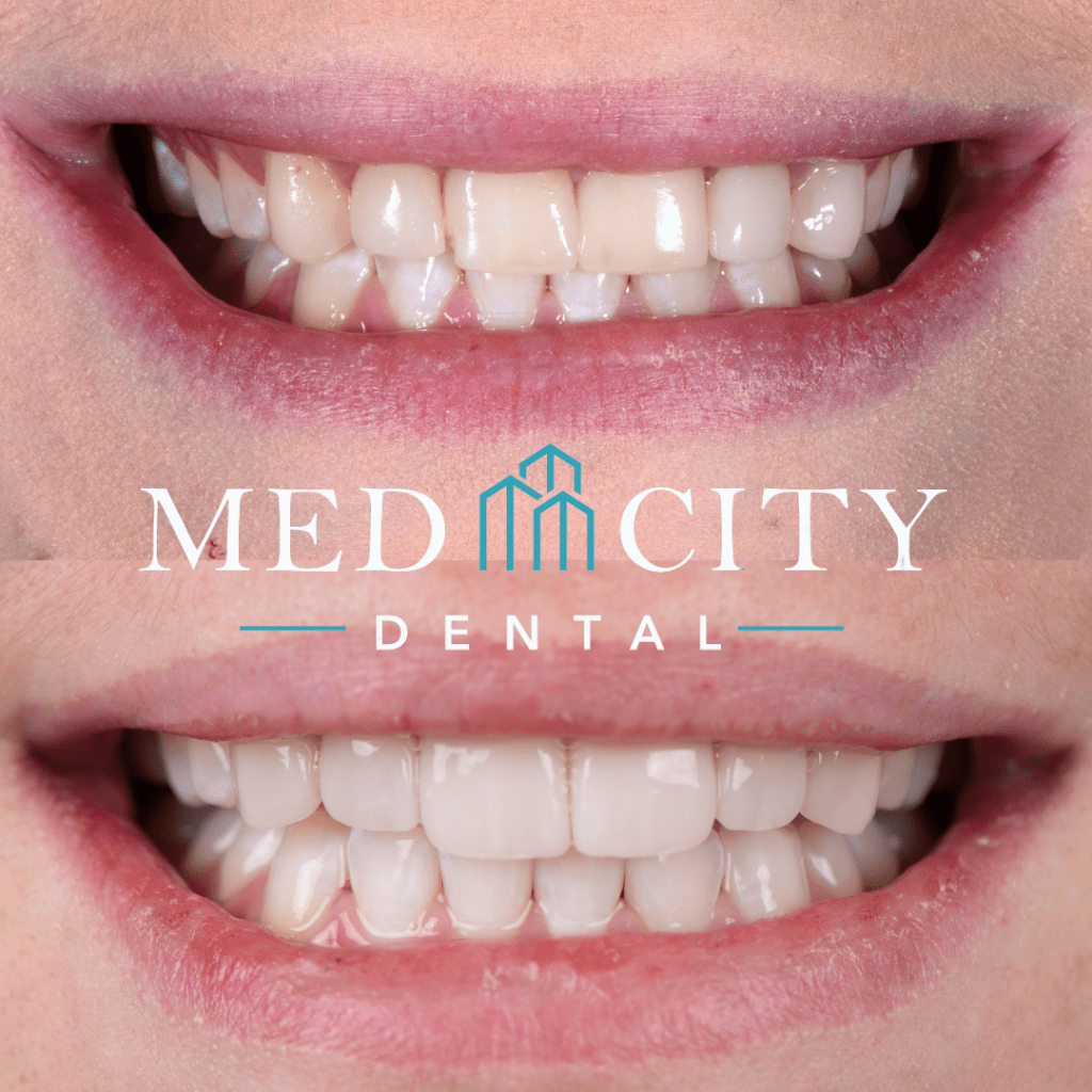 Paige Veneers Before and After