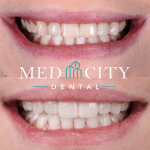 Paige Veneers Before and After