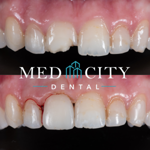 Smile Design