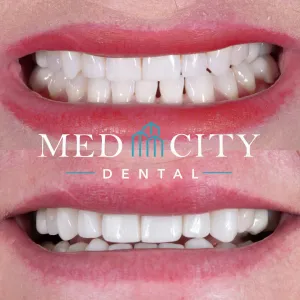 Smile makeover